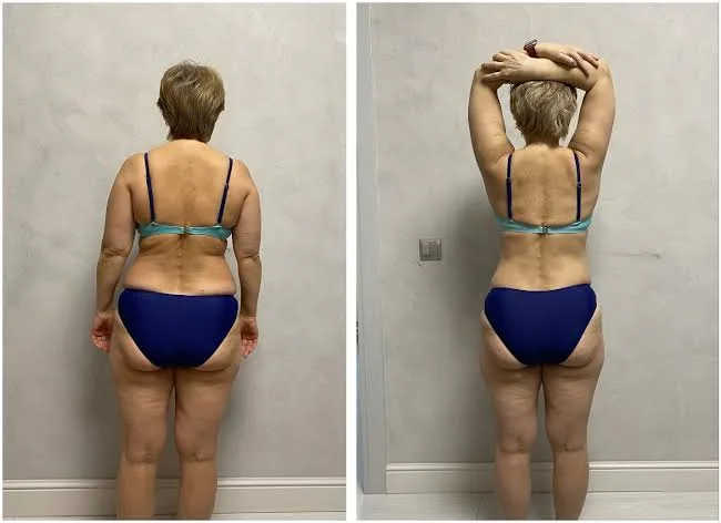 Registro de antes e depois de costas compartilhado por praticante do Método P30